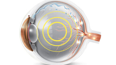 tratamento com laser para glaucoma