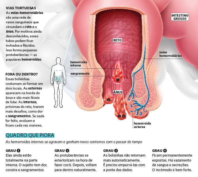 Hemorroidas o que são como surgem e quais os tratamentos disponíveis